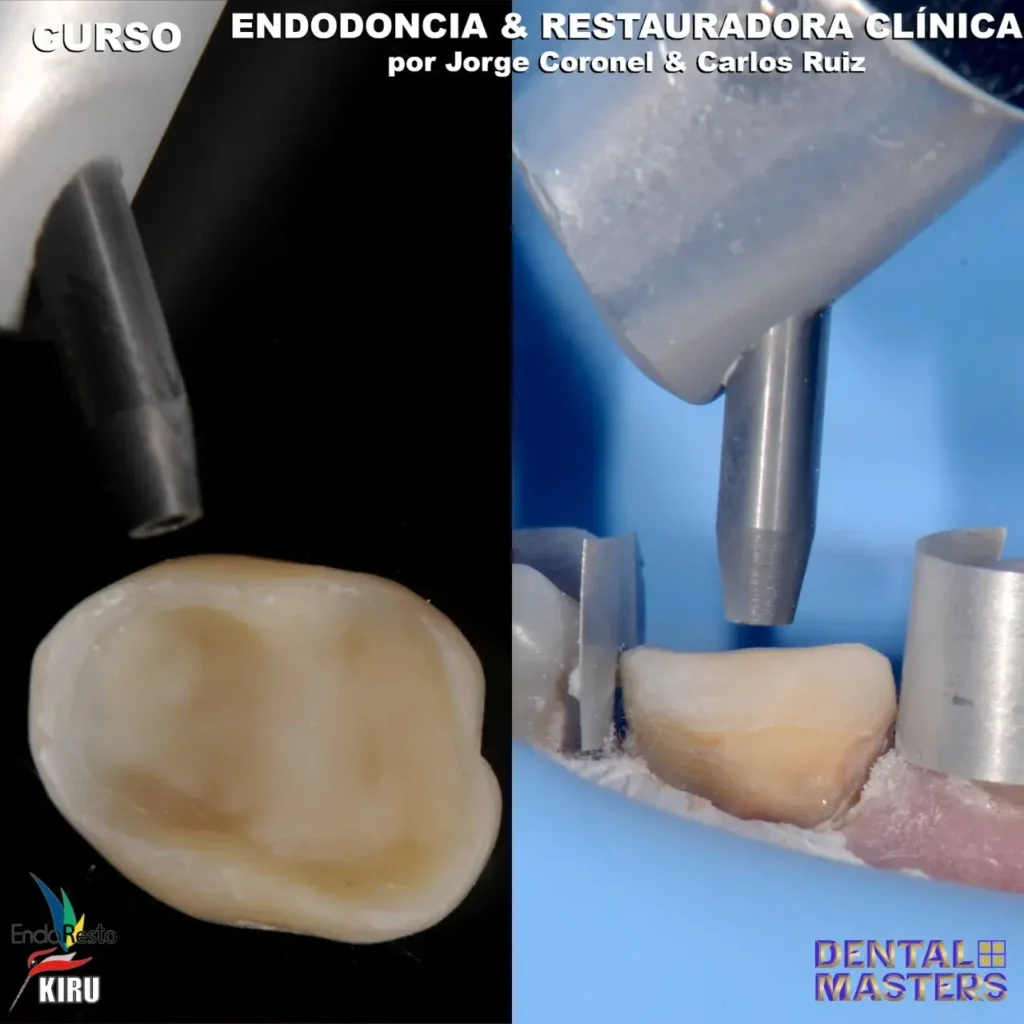 curso-endodoncia-y-restauradora-clinica